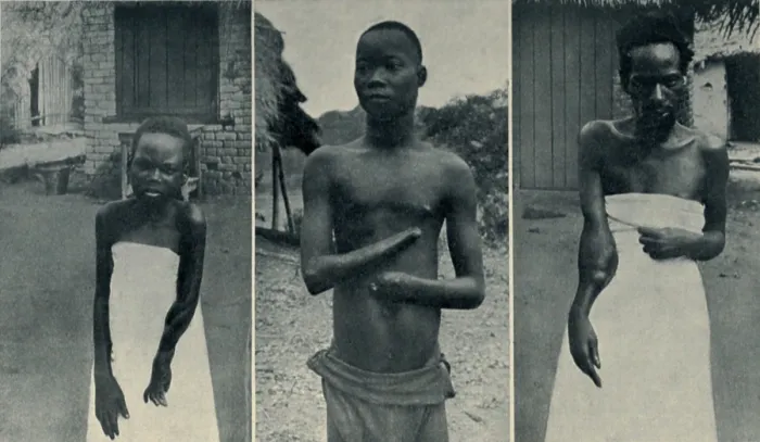 Framed Print : Atrocities of the Rubber Slavery in the Belgian Congo