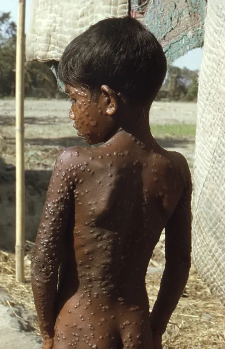 Framed Print : Bangladeshi youth with Smallpox in 1974, has the typical rash covering his entire body with pustules. The last naturally occurring case in the world was in Somalia in 1977 Framed Print : Bangladeshi youth with Smallpox in 1974, has the typical rash covering his entire body with pustules. The last naturally occurring case in the world was in Somalia in 1977