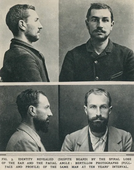 Framed Print : Bertillon system photographs taken at a ten year's interval, reveal it is the same man by the spiral lobe of the ear and the facial angle Framed Print : Bertillon system photographs taken at a ten year's interval, reveal it is the same man by the spiral lobe of the ear and the facial angle