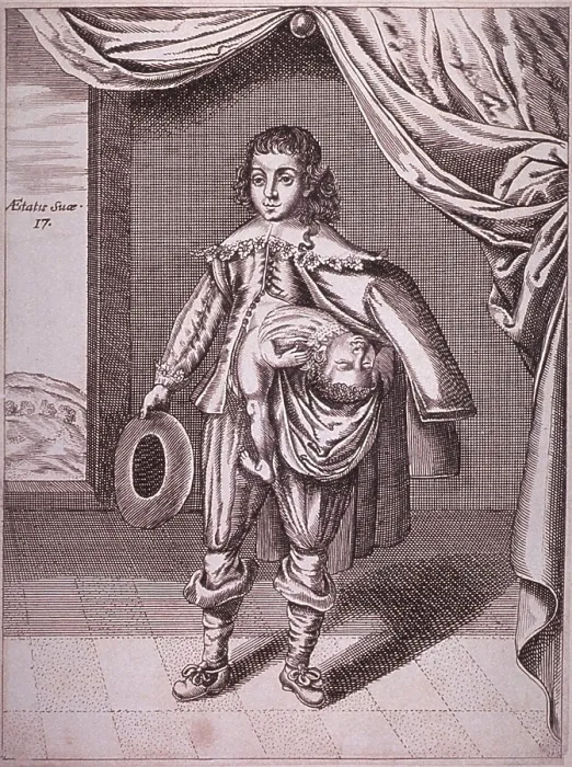 Framed Print : Boy with a deformity caused by a partial conjoined twin growing from his side. 1686 engraving