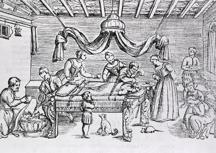 Framed Print : Brain surgery in the 16th century. A surgeon bores a hole in the patient's skull while several assistants perform various tasks