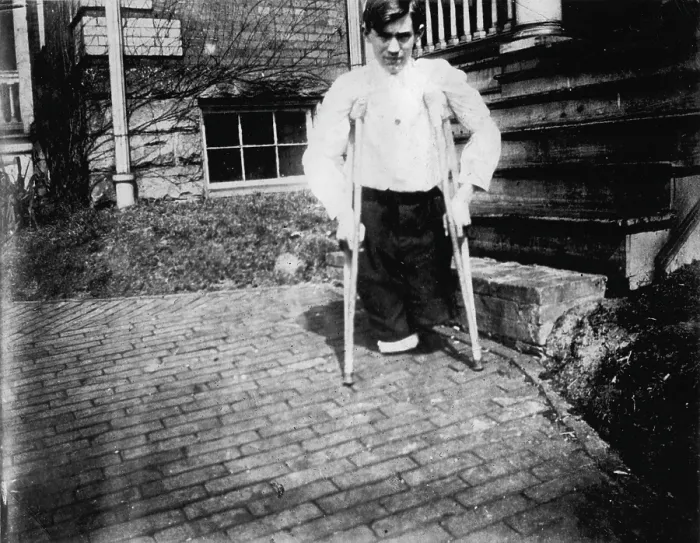 Framed Print : Child labor, Frank P. legs were cut off by a motor car in a coal mine when he was 14 years of age, Monongah, West Virginia, photograph by Lewis Wickes Hine, March, 1910