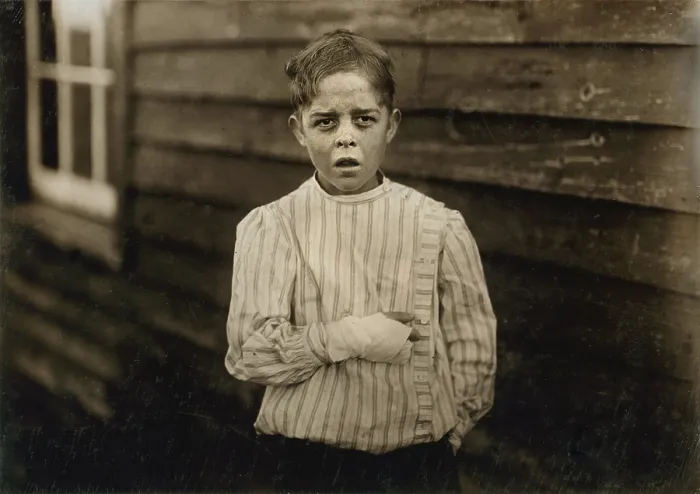 Framed Print : Child Labor, Giles Edmund Newsom, while working in Sanders spinning mill, a piece of the machine fell onto his foot mashing his toe, causing him to fall to a spinning machine