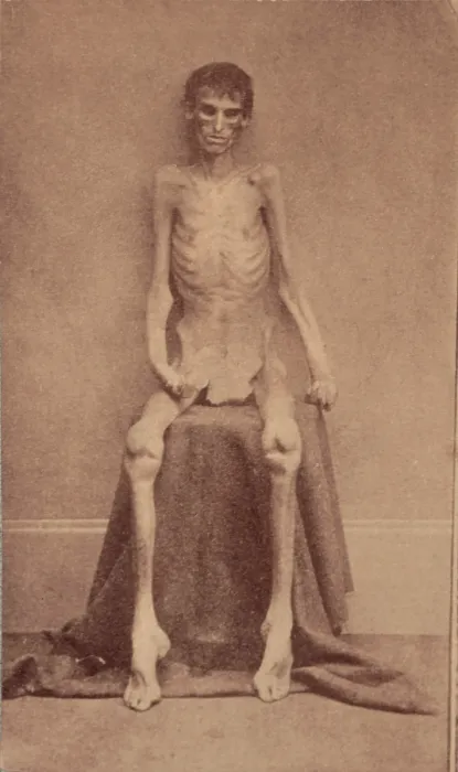 Framed Print : The Civil War, A Federal prisoner, returned from prison, full-length, seated, nude, facing front, 1861-1865