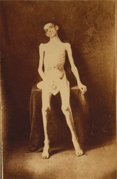 Framed Print : The Civil War, A Federal prisoner, returned from prison, standing, full-length, nude, facing front, photograph, 1861-1865