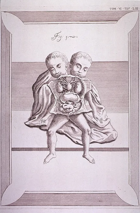 Framed Print : Conjoined twins with common torso and limbs, and the two heads. The abdomen and chest cavities are dissected open to show the organs. 18th century Italian engraving