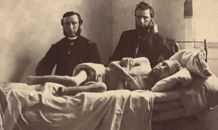 Framed Print : Corporal Calvin Bates of Co. E, 20th Maine Infantry Regiment, lies in a hospital bed after the amputation of his gangrenous feet