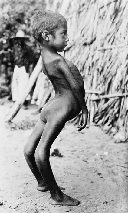 Framed Print : Deformed Mexican boy, original title: Freak Mexican Boy, Photograph by A.R. Alexander, circa 1915