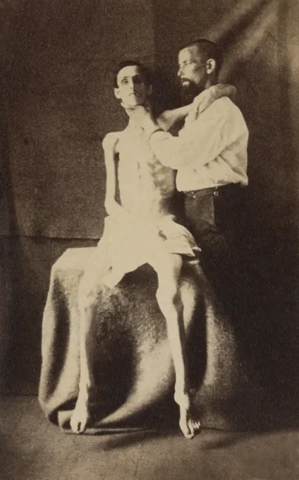 Framed Print : This emaciated Union soldier was released from Belle Isle POW prison in Richmond, during the US Civil War. Photo was taken while he received treatment at the U.S
