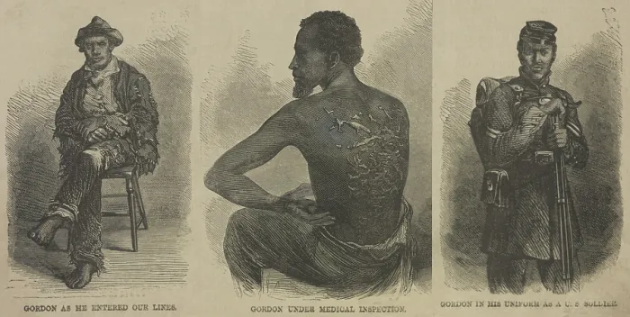 Framed Print : Escaped slave Gordon, whose scarred back from whipping is evidence of the brutality of American slavery Framed Print : Escaped slave Gordon, whose scarred back from whipping is evidence of the brutality of American slavery