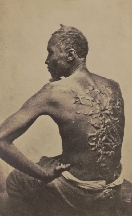 Framed Print : Escaped slave Gordon, showing his scarred back at a medical examination, Baton Rouge, Louisiana Framed Print : Escaped slave Gordon, showing his scarred back at a medical examination, Baton Rouge, Louisiana