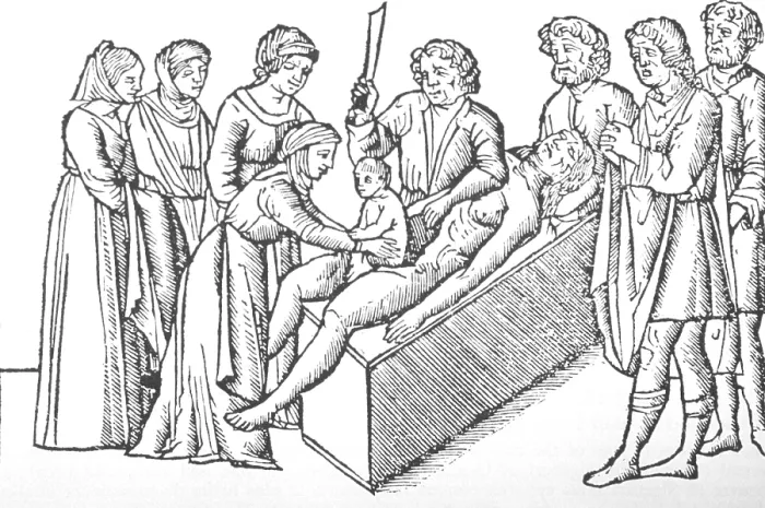 Framed Print : Illustration of the birth of Julius Caesar, by Cesarean section from a 1506 edition of Suetonius, THE TWELVE CESARS Framed Print : Illustration of the birth of Julius Caesar, by Cesarean section from a 1506 edition of Suetonius, THE TWELVE CESARS