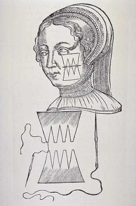Framed Print : Illustration of suture technique that minimized scarring from a face wound of a women. From Ambroise Pare's, DIX LIVRES DE LA CHIRURGIE (TEN BOOKS ON SURGERY), 1564 Framed Print : Illustration of suture technique that minimized scarring from a face wound of a women. From Ambroise Pare's, DIX LIVRES DE LA CHIRURGIE (TEN BOOKS ON SURGERY), 1564