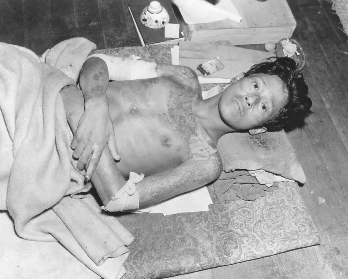 Framed Print : Japanese male victim of the atom bomb explosion over Nagasaki, Japan. Sept.-Dec. 1945. (BSLOC_2014_6_95)