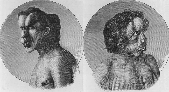 Framed Print : Joseph Merrick (1862-1890), known as the Elephant Man, suffered from Neurofibromatosis, a congenital disorder