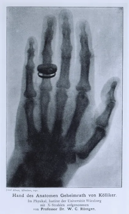 Framed Print : Konrad Roentgen's X-ray of the hand of Professor Albert von Kolliker, showing bones and the ring he was wearing