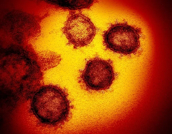 Framed Print : Novel Coronavirus SARS-CoV-2, causes coronavirus disease-2019, abbreviated as COVID-19