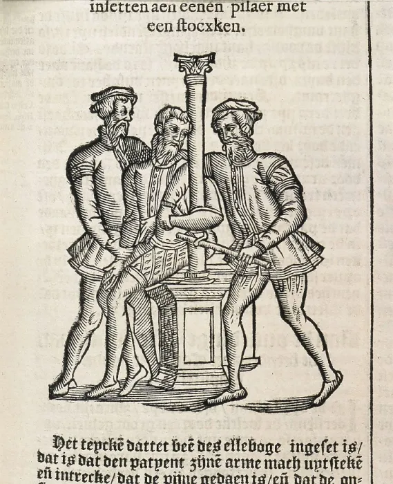 Framed Print : PARE, Ambroise (1509-1590). 'De Chirurgie' (On Surgery). Edition executed in Amsterdam (1636). Xylography. FRANCE. Paris. National Library