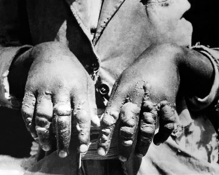 Framed Print : Second Italo-Ethiopian War. Evidence of Italian use of mustard gas used against Ethiopian forces at Dolo. Blistered hands of a victim were caused by mustard gas. Jan. 1936