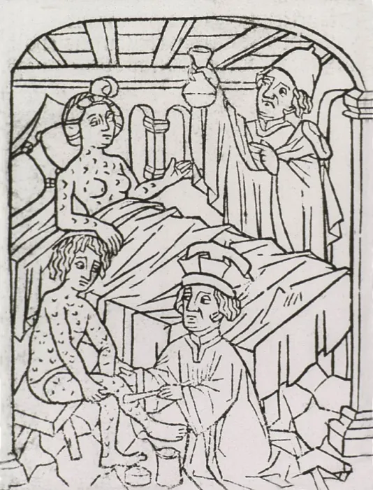Framed Print : Syphilis In Europe. A woman in bed and a man sitting on a stool are covered with venereal disease lesions