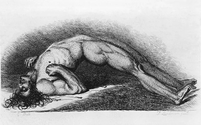 Framed Print : Tetanus (Lockjaw) victim. The contracted body of soldier suffering from tetanus. Engraving from painting by Charles Bell, 1809