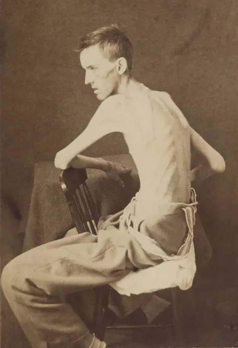 Framed Print : Union Private Jackson O. Brashears, as he appeared upon release from Confederate Belle Isle POW prison in Richmond, March 1864 Framed Print : Union Private Jackson O. Brashears, as he appeared upon release from Confederate Belle Isle POW prison in Richmond, March 1864