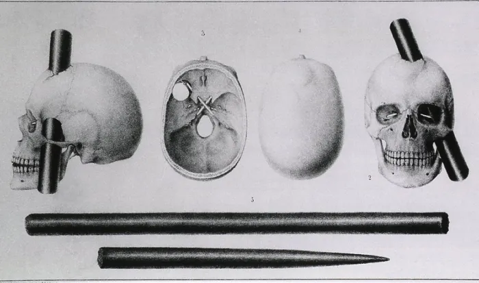 Framed Print : Various views of the famous wound in the skull of Phineas Gage, (1823-1860), showing wound made by iron rod and the rod itself