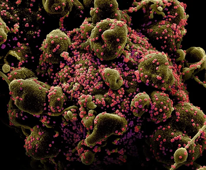 Framed Print : VERO E6 cell (blue) heavily infected with SARS-COV-2 virus particles (orange), isolated from a patient sample Framed Print : VERO E6 cell (blue) heavily infected with SARS-COV-2 virus particles (orange), isolated from a patient sample
