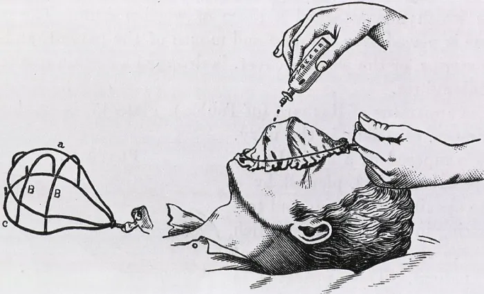 Framed Print : Wire frame supports a muslin cloth cover placed over the patient's face while drops of chloroform are dripped on the cloth. The wire frame without cover is shown on the left