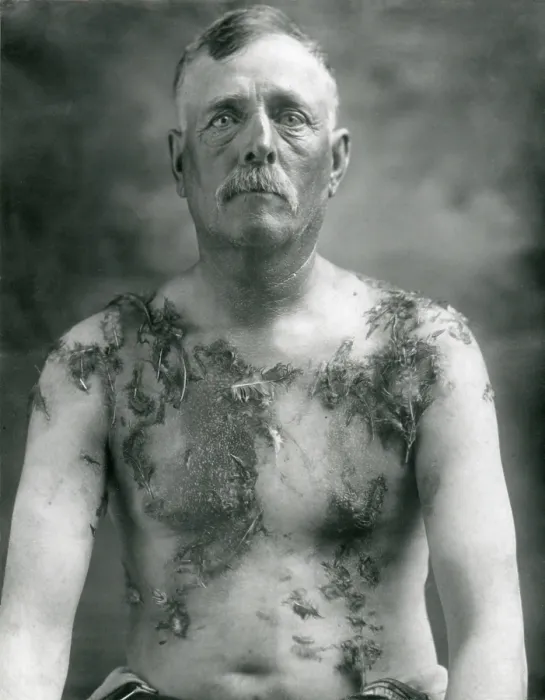 Framed Print : World War 1. John Meintz, a German-American farmer of Luverne, Minnesota, was tarred and feathered by Anti-German vigilantes on August 19, 1918