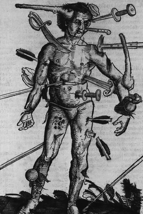 Framed Print : WOUND MAN. A man with wounds from many different kinds of weapons from a field manual for military surgeons Framed Print : WOUND MAN. A man with wounds from many different kinds of weapons from a field manual for military surgeons