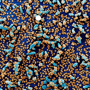 Digital Image Prints: Apoptotic cell (blue) infected with SARS-COV-2 virus particles (red)