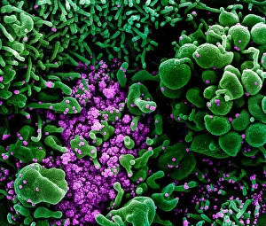 Digital Image Prints: Apoptotic cell (green) heavily infected with SARS-COV-2 virus particles (purple)