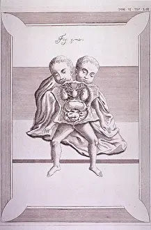 1700s Prints: Conjoined twins with common torso and limbs