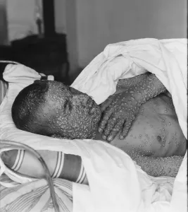 Sick Prints: The heavily pockmarked face, arms and hands of a smallpox victim in Palestine