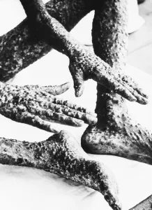 Sick Prints: The heavily pockmarked hands, legs