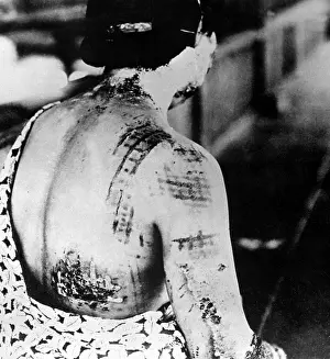 A Bomb Prints: Injured female survivor's of Nagasaki