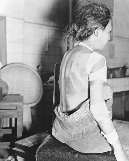 A Bomb Prints: Japanese female victim of atom bomb