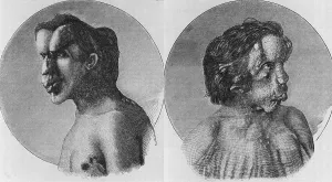 Illnesses Prints: Joseph Merrick (1862-1890), known as the Elephant Man