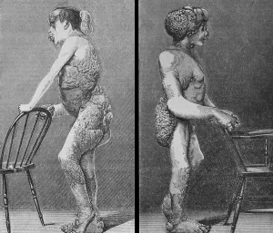 Joseph Merrick (1862-1890), known as the Elephant Man, suffered from Neurofibromatosis, a congenital disorder