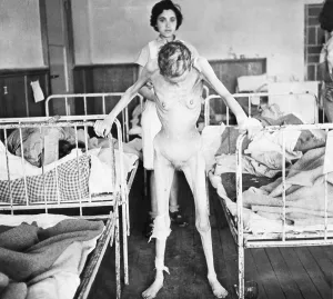 Naked Prints: Margit Schwartz, 31 years old Hungarian Jew in the hospital at Belsen Concentration Camp
