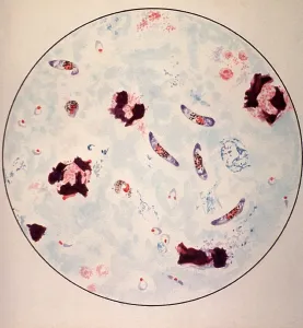 Sick Prints: Microscopic view of a malaria parasite painted from microscopic view from a manual to assist in malaria diagnosis among