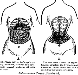 Bones Prints: Nature Versus Corsets. At left is the natural arrangement of a woman's internal anatomy