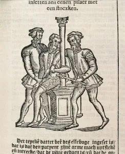 Pare Prints: PARE, Ambroise (1509-1590). 'De Chirurgie' (On Surgery)