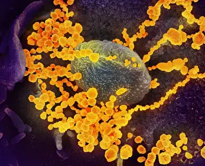 Digital Image Prints: SARS-CoV-2 (round gold objects) emerging from the surface of patient cells cultured in the lab