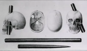 Various views of the famous wound in the skull of Phineas Gage, (1823-1860), showing wound made by iron rod and the rod itself