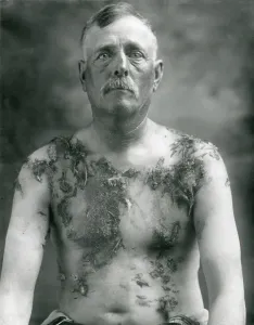 Intolerance Prints: World War 1. John Meintz, a German-American farmer of Luverne