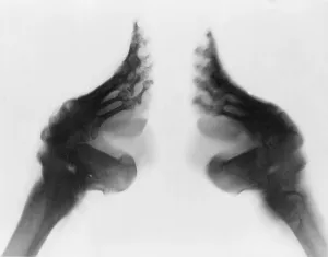 X Ray Prints: X-ray of a woman's bound feet, China. Ca. 1890-1923